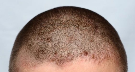 Угревая сыпь на голове: причины и лечение