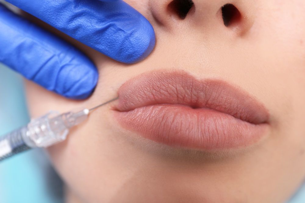 Гиалуроновая кислота – инъекция для пухлых губ